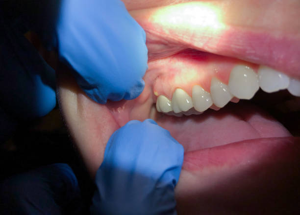 Best Walk-In Emergency Dentist in Glouster, OH