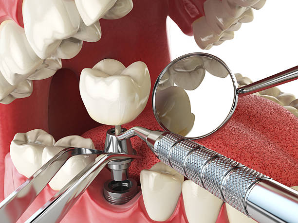 Best Emergency Tooth Extraction in Glouster, OH
